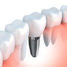 Animation of implant supported dental crown