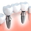 Animation of implant supported dental bridge