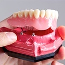 Model implant supported denture