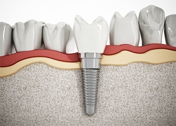 Animation of implant supported replacement tooth