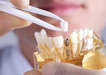 Model of implant supported dental crown