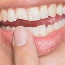 Closeup of chipped front tooth