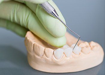 Model smile with fixed bridge restoration