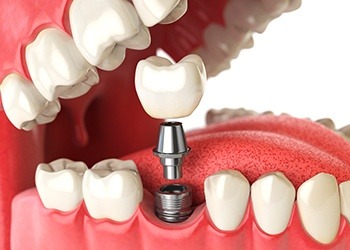 Animation of dental implant supported tooth replacement